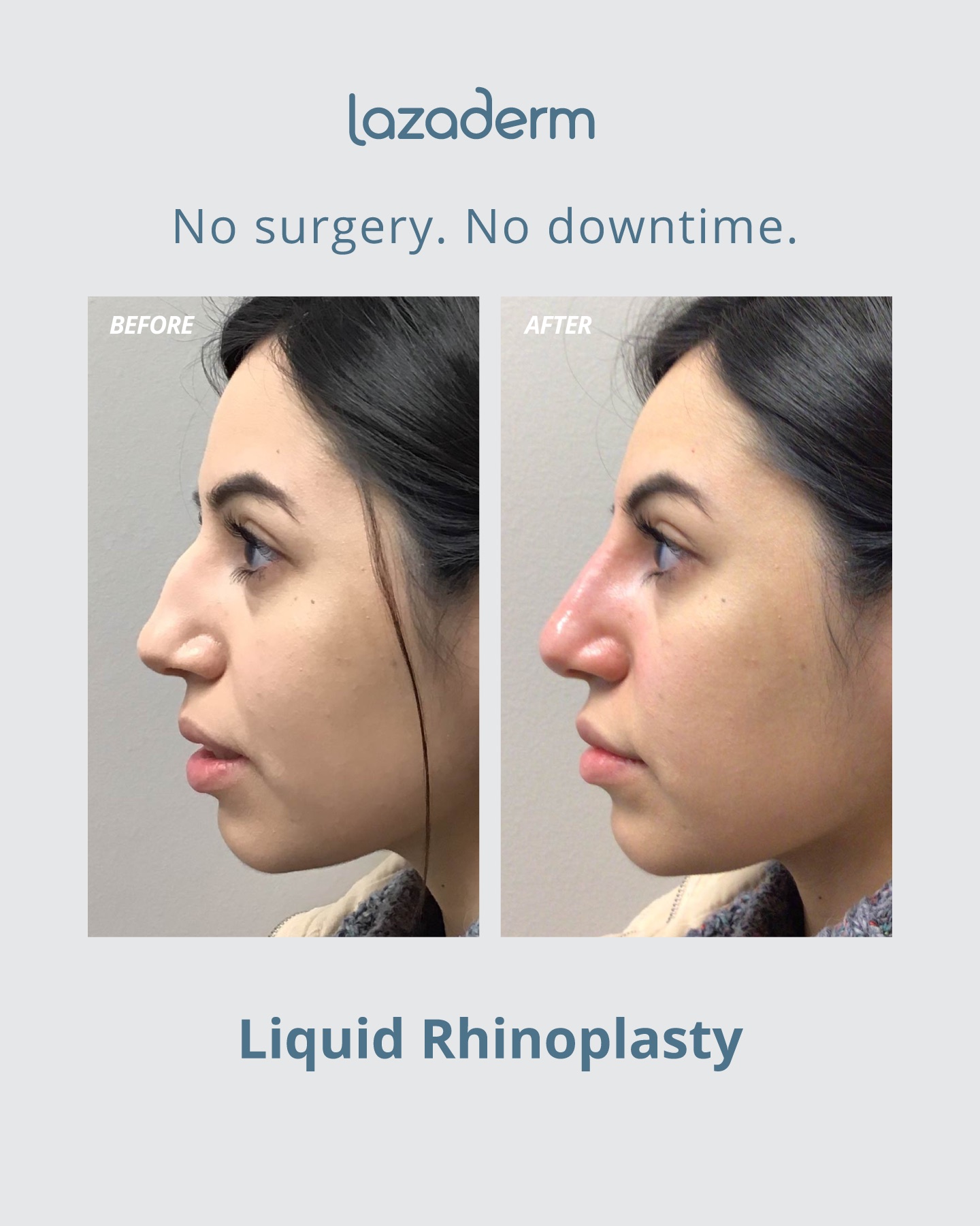Before and after aesthetic treatment at Lazaderm, patient 1