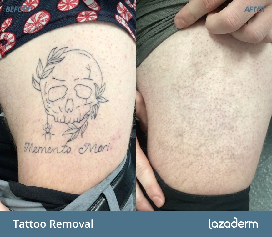 Before and after aesthetic treatment at Lazaderm, patient 2
