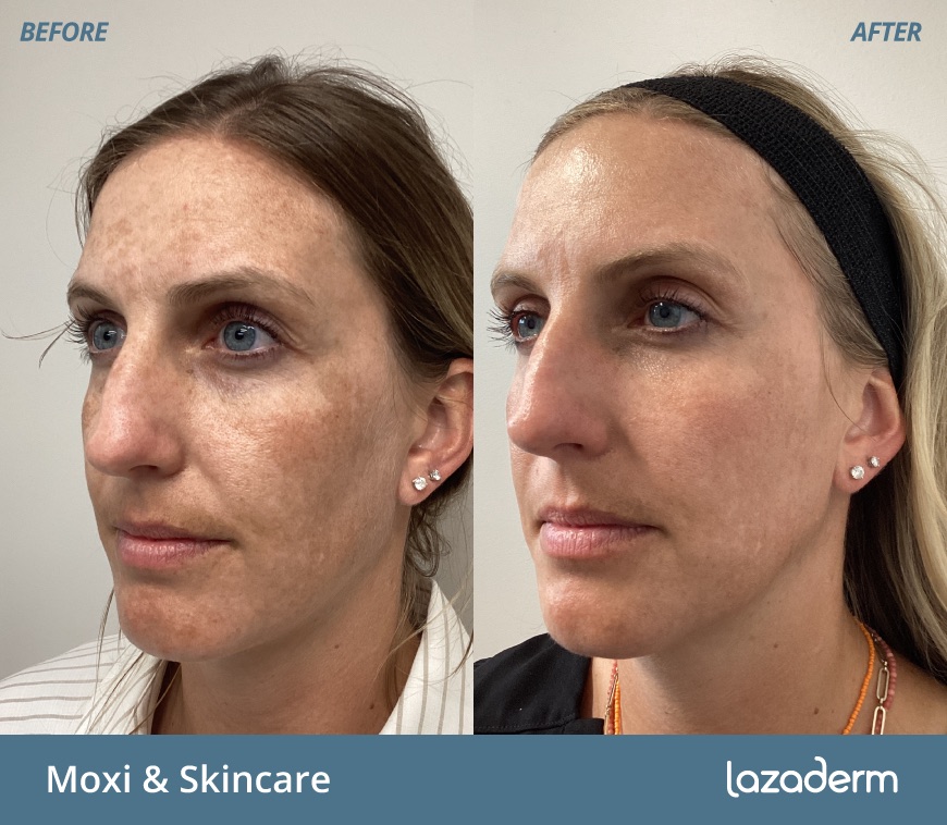 Before and after aesthetic treatment at Lazaderm, patient 1
