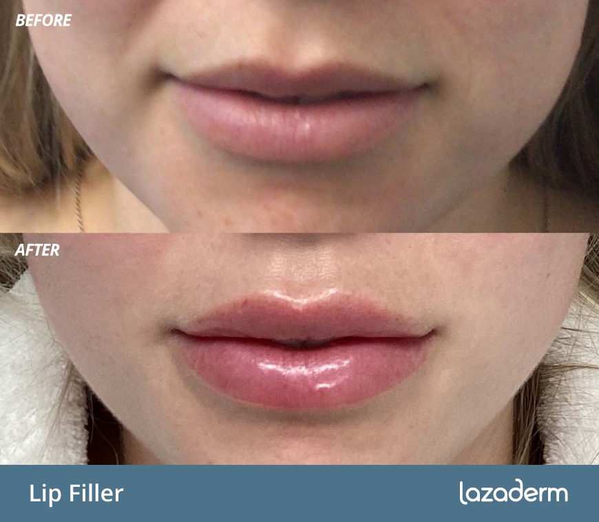 Before and after aesthetic treatment at Lazaderm, patient 2