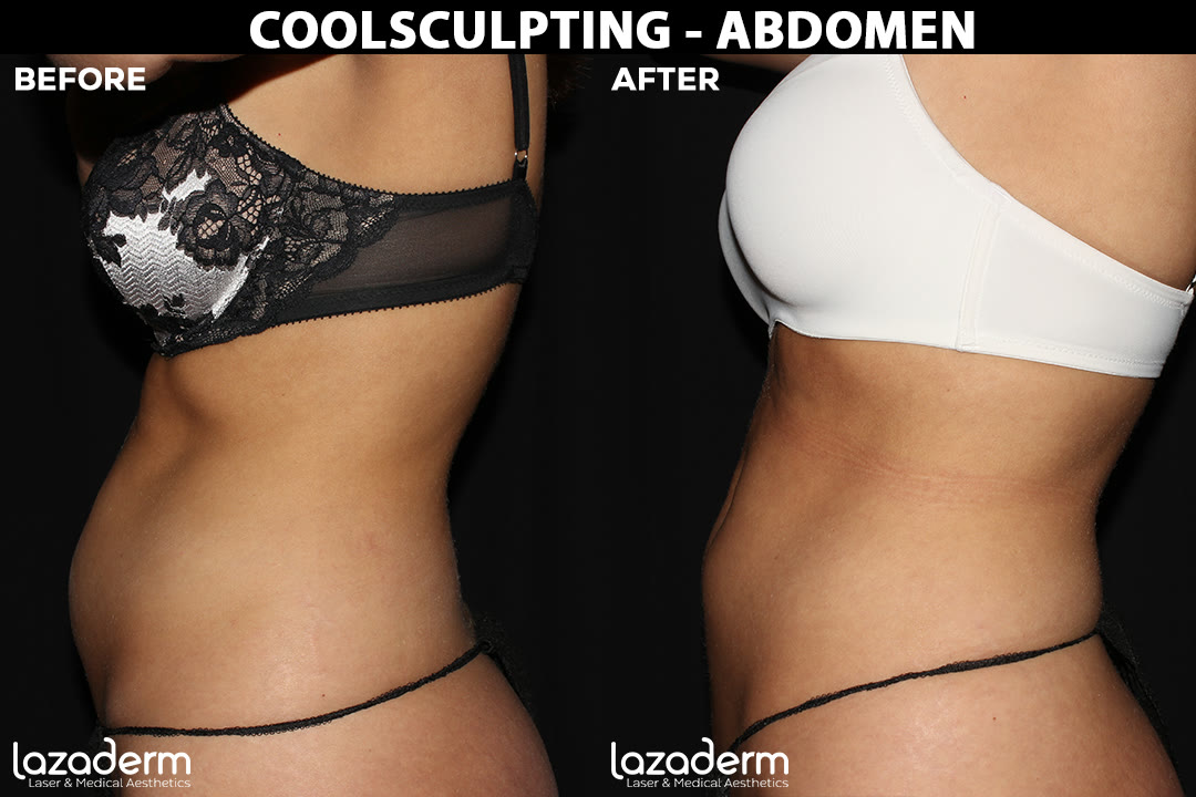CoolSculpting Elite before and after, patient abdomen