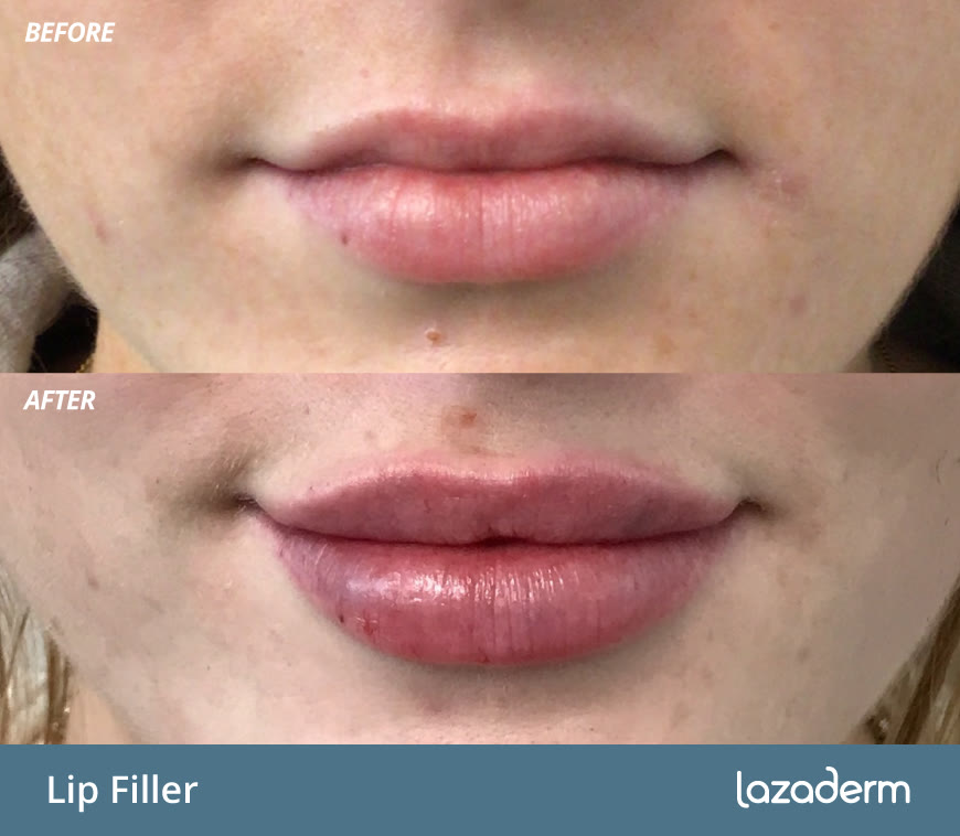 Dermal filler before and after, patient results