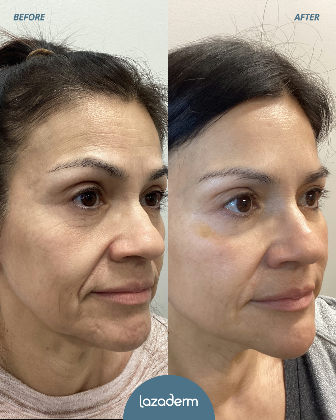 Dermal filler before and after, facial volume