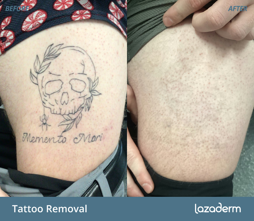 Before and after laser hair or tattoo removal, patient results