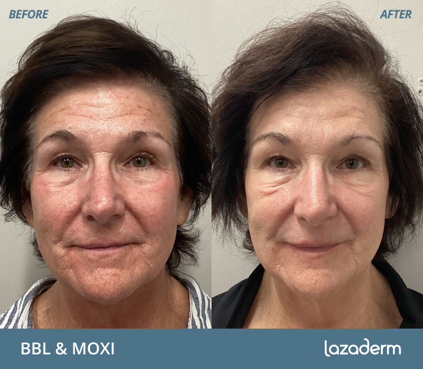 Laser skin treatment before and after, patient results