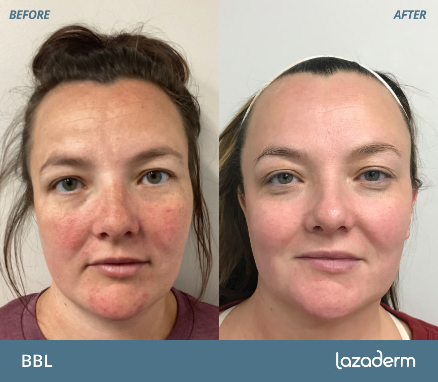 Laser skin treatment before and after, patient results
