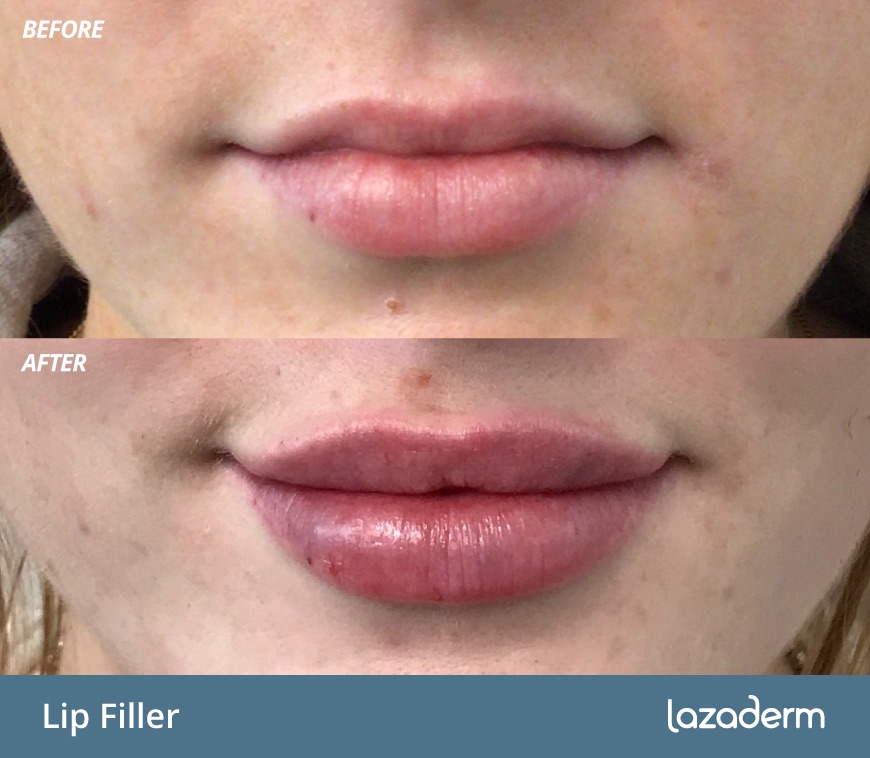 Before and after aesthetic treatment at Lazaderm, patient 2