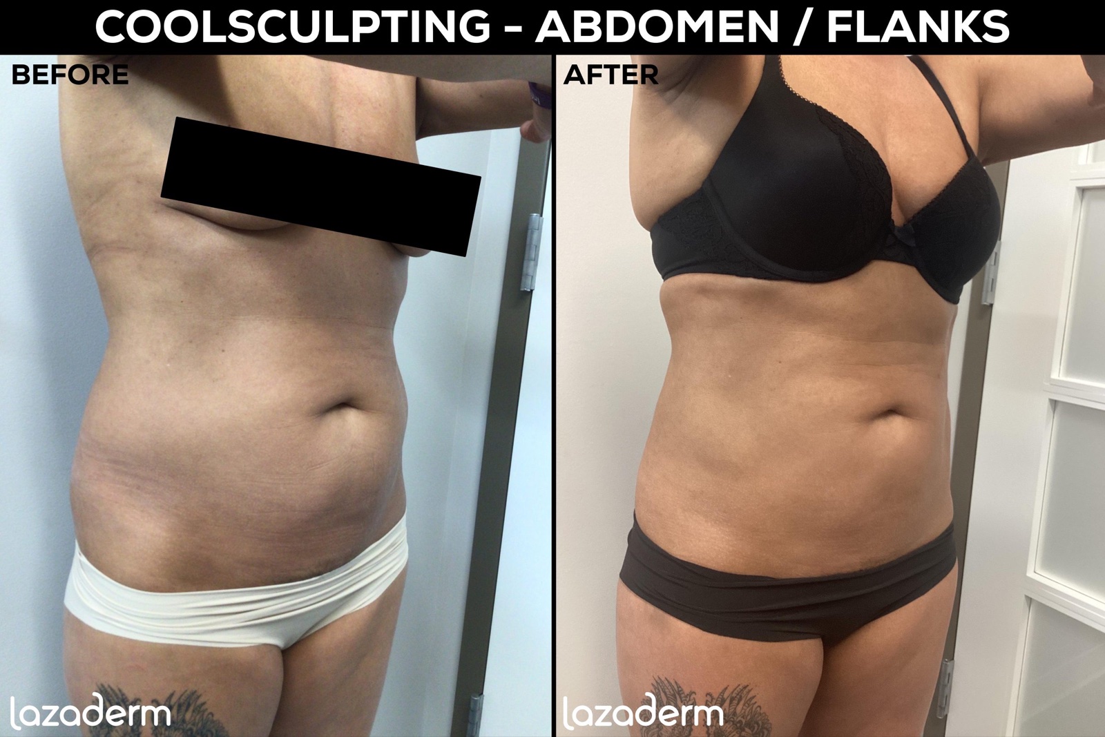 Before and after aesthetic treatment at Lazaderm, patient 1