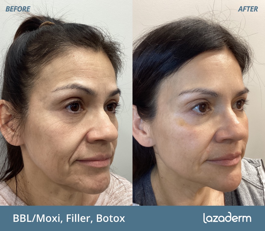 Before and after aesthetic treatment at Lazaderm, patient 2