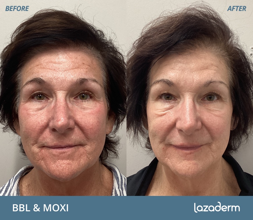 Before and after aesthetic treatment at Lazaderm, patient 1